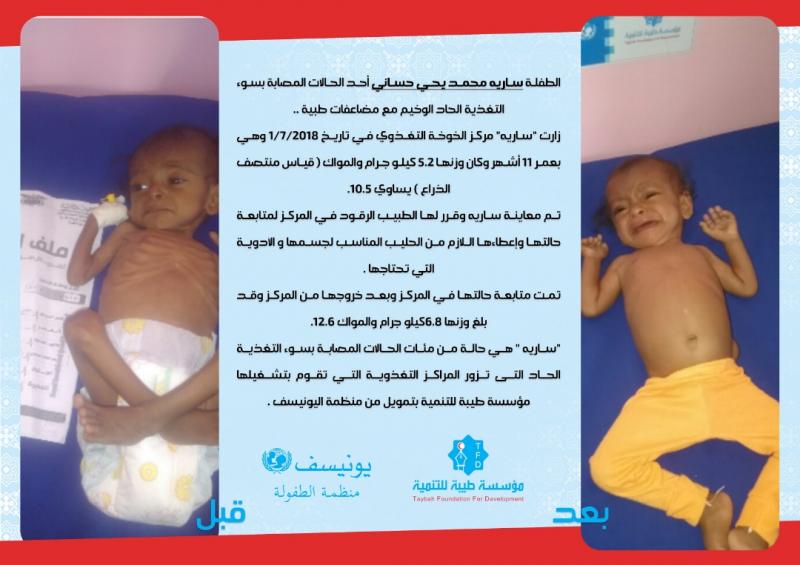 الطفلة سارية محمد يحي حساني أحد الحالات المصابة بسوء التغذية  الحاد الوخيم مع مضاعفات طبية 